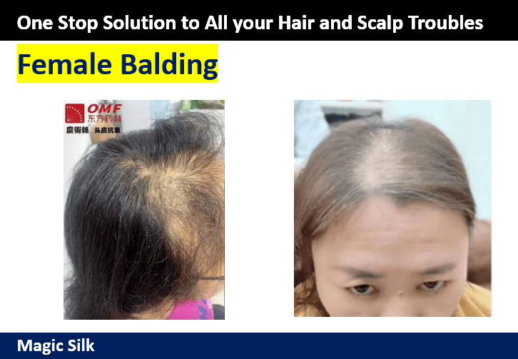 Female Balding Problem