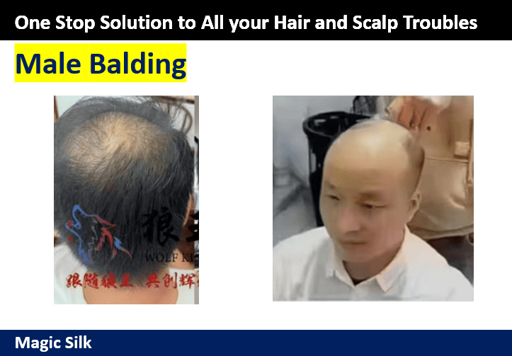 Causes of Balding